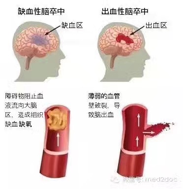 什么是脑梗死？